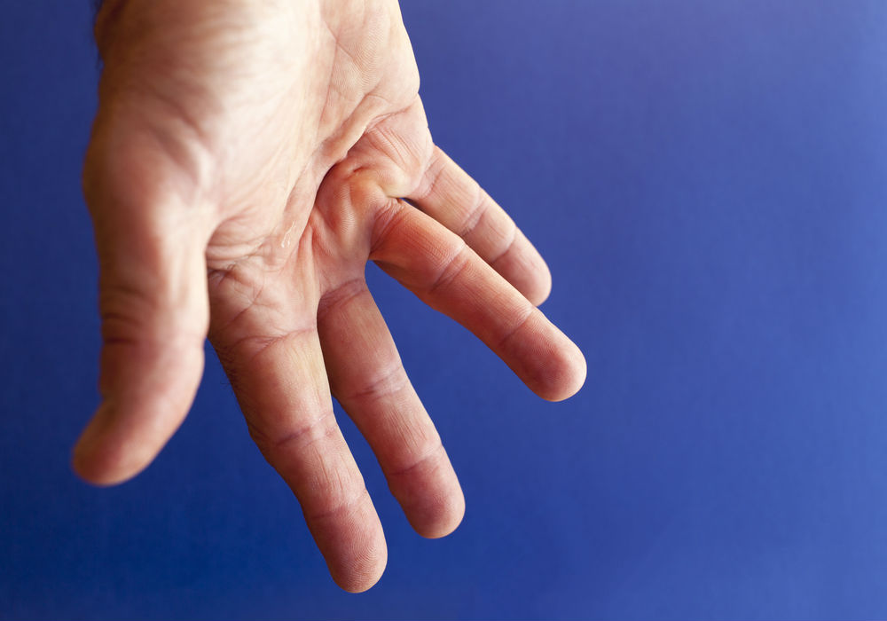 Top 3 Dupuytren’s Contracture Treatment Options