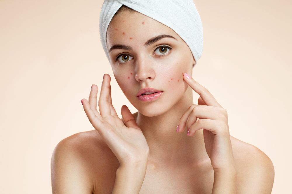 Best Acne Treatments for Oily Skin